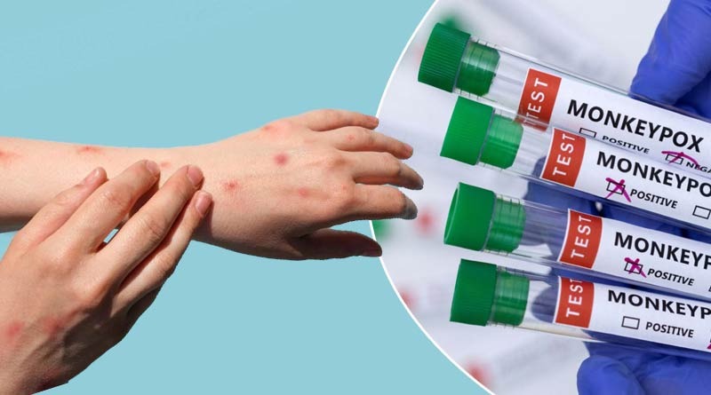 Monkeypox Rash Procaution Monkeypox arrives in India. How to take precautions against it | Piccle